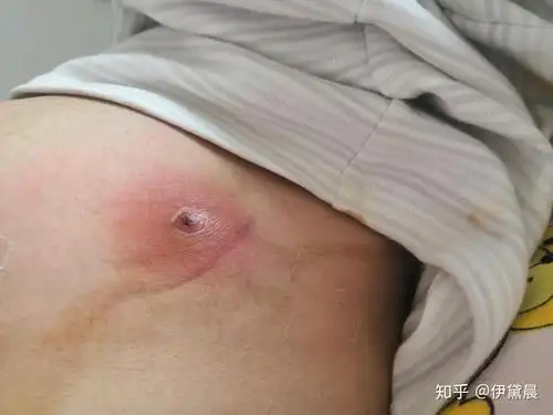 哺乳期如何治疗胸部毛囊炎