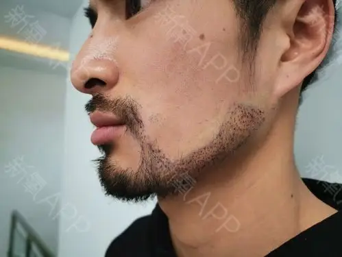 种植胡须好不好_效果图_氧气zxvfz种植胡须术后第0天_新氧美容整形