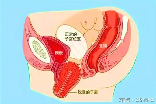 生完孩子臀部变宽子宫脱垂如何预防收腹真的有效果吗