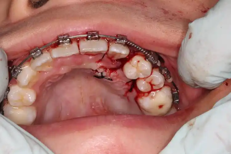 阻生尖牙的拔除