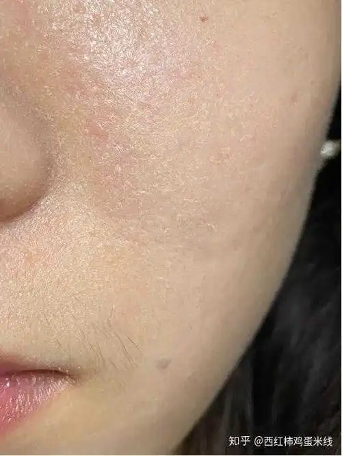 脸部皮肤过敏该用什么护肤品修复?