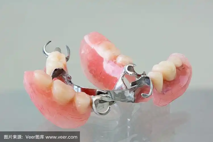 带有金属弧线的卡环假牙