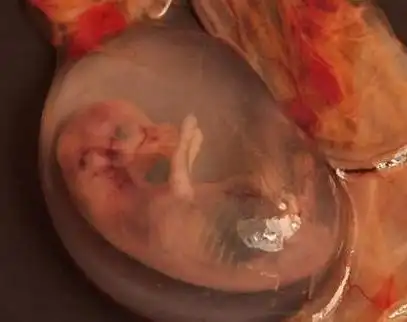 引产后的宝宝还有呼吸,医生的做法,难道就不觉得心痛吗