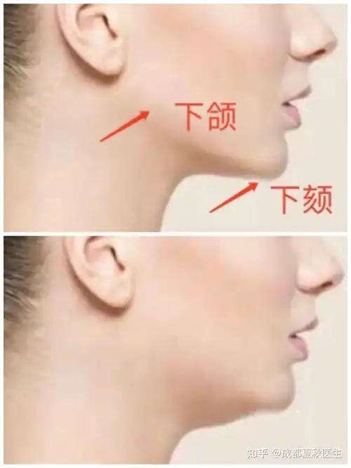下颌线不清晰,都是胖出来的?