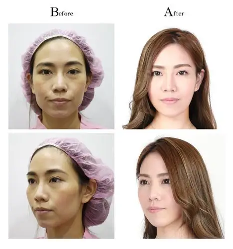 自体脂肪移植手术前后比对案例心得日记 台中教主医美整形外科诊所