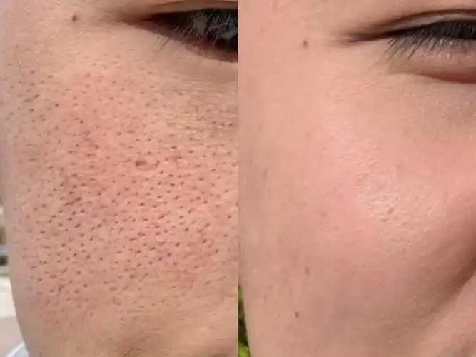 【男生毛孔粗大必看】男士收缩毛孔用什么最好最有效?医学生教你4步,1