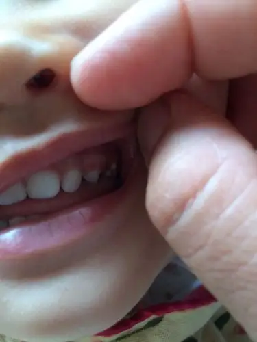 宝宝一周半牙齿早就长齐了,今天发现她左上边大牙外又长出了一颗小牙