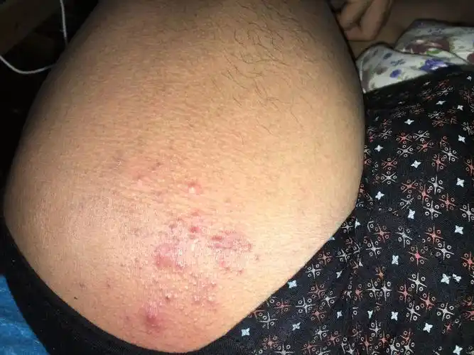 我怀疑自己感染艾滋病了?