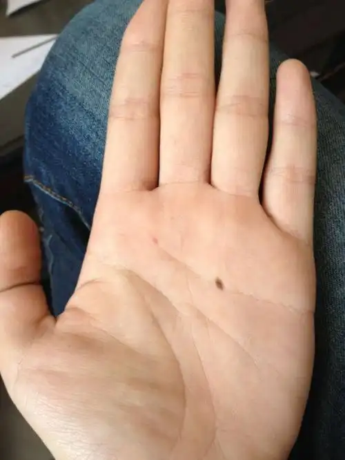掌心有痣,经商旺财,从政高升