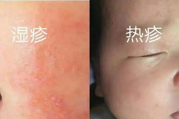 月子里的宝宝爱出疹子,湿疹,热疹如何区分