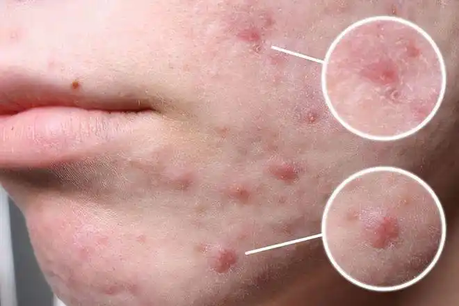 皮肤的油脂分泌量变多之后就容易堆积在毛孔里面,使毛空容易发生堵塞