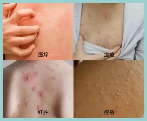 引发皮炎,毛囊炎,湿疹,皮肤过敏等一系列皮肤问题.