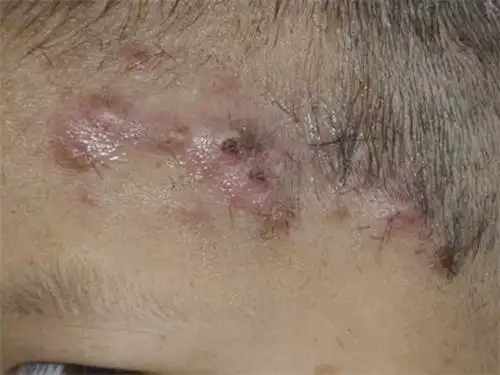 炎症继续发展,结节增大,疼痛加剧.