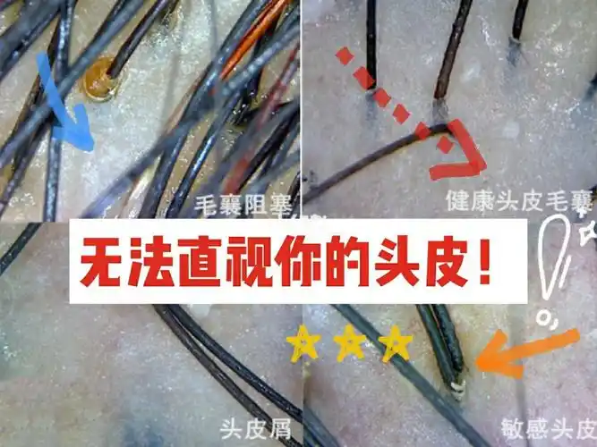 一组重口味图片提醒你及时拯救头皮健康