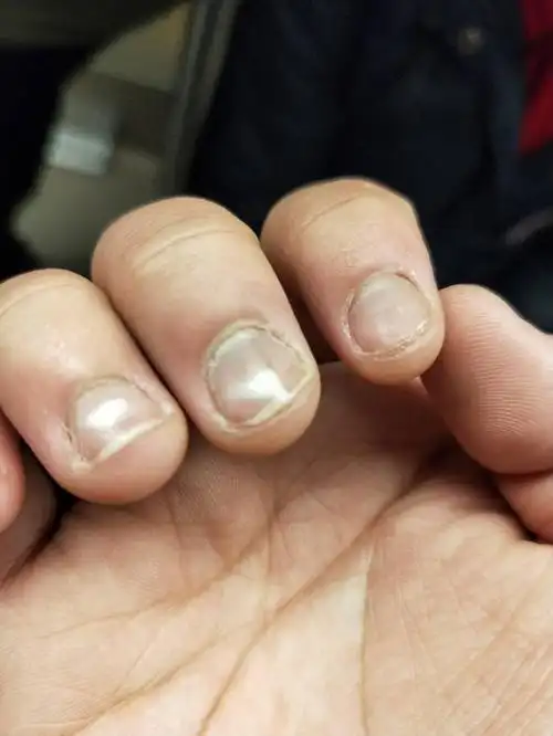 展开全部 很多人都会遇到指甲上出现白色的斑点的情况,指甲上白色的