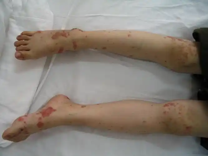 过敏性紫癜怎么治疗_过敏性紫癜_北京京城皮肤病医院(北京医保定点