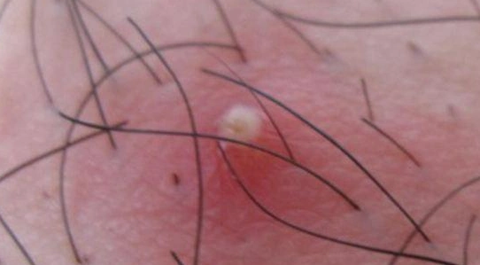 细菌感染性毛囊炎怎么治疗_毛囊炎_治疗方式_日常注意事项 - 好大夫