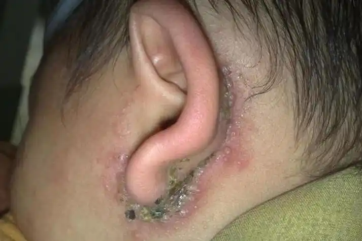 耳朵后面亚急性湿疹图