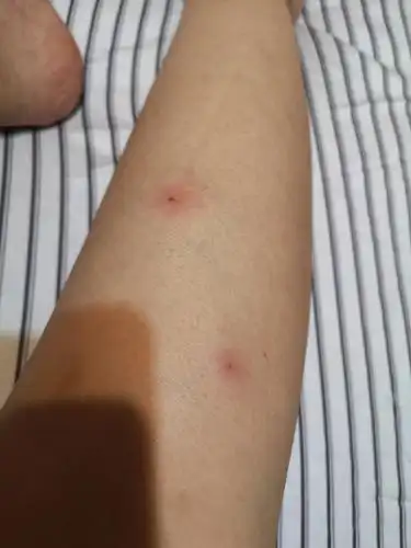 【讨论】这是被跳蚤咬的吗?