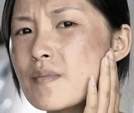 一些年轻人日常中不重视自己的生活习惯,也出现了肤色暗沉,长斑的情况