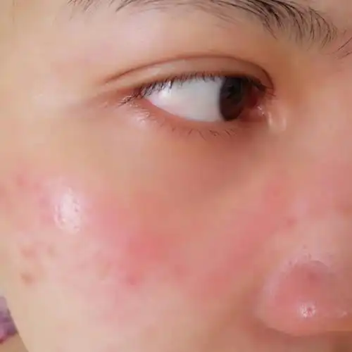 过敏发痒.怎么办?