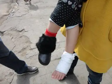 4岁小女孩火锅店被烫伤 赔偿费引纠纷