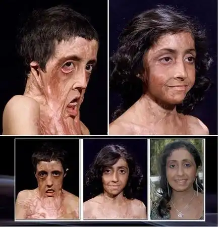 燃煤爆炸毁容 印度女孩浴火重生:长大要当医生助人