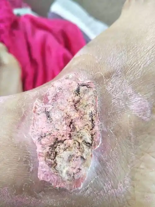 烫伤二十天结痂了,多久能退掉