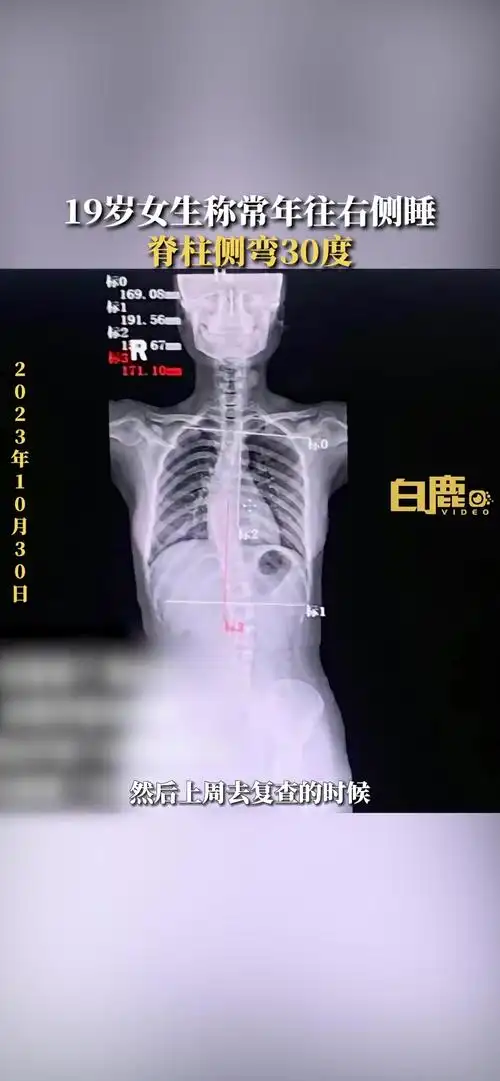 19岁女生称常年侧睡脊柱侧弯30度 成都 健康(来源:)