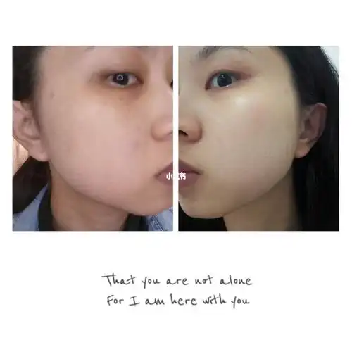 光子嫩肤后十一天前后对比