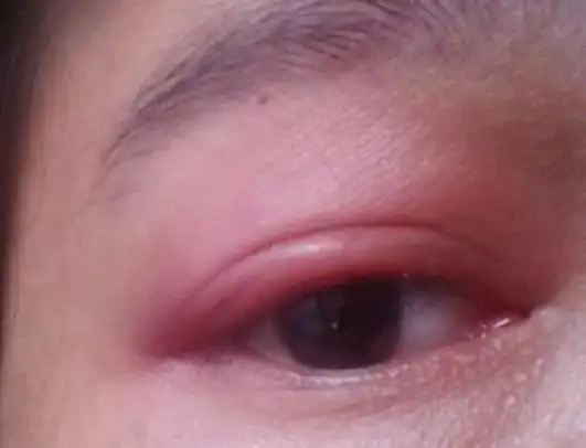 早起眼皮肿是怎么回事  眼皮肿适合画什么眼影