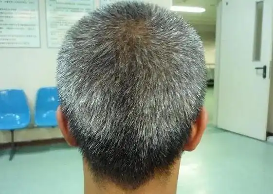 白发长在哪,病就从哪出?长在前额,两鬓,后脑勺,分别代表什么