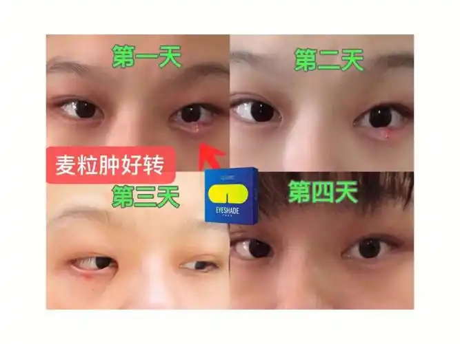 戴79天眼罩麦粒肿好了