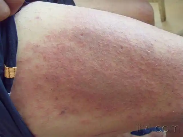 爱爱医病例中心 皮肤性病科 皮肤科 看图识病:夏季皮炎