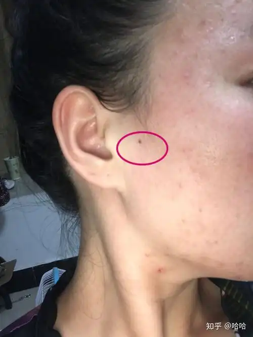 耳屏有痣的女人,女人耳朵轮廓有痣图解大全