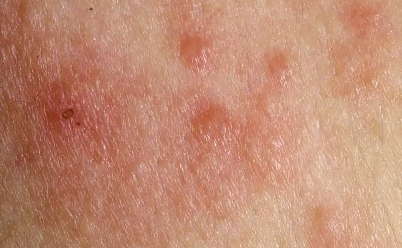 面部皮肤炎治疗, 过敏性皮肤炎治疗, 皮肤炎治疗, 皮肤炎留下色印