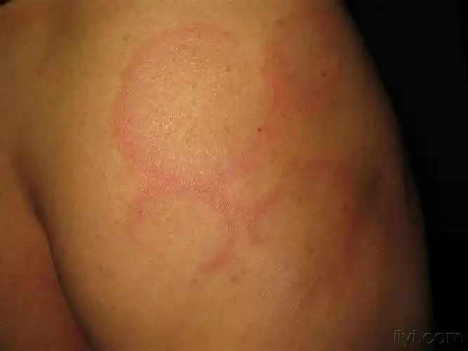 不痛不痒的红圈圈.