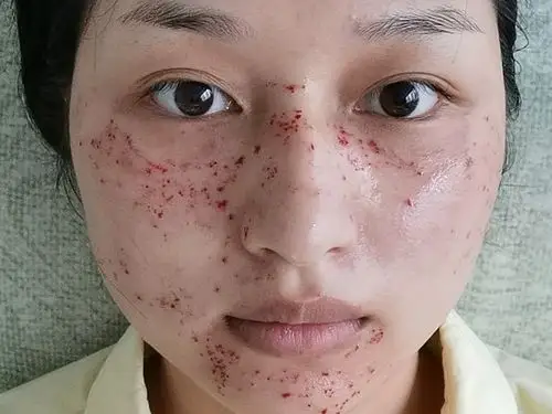 96年女脸上真皮斑黄褐斑雀斑