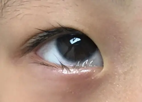 先天性睑内翻的病因手术时机及方法简介