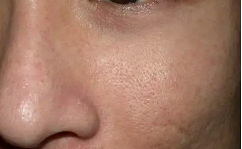 这些毛孔粗大的原因,你肯定没想到