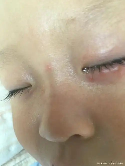 有在线的医生帮忙看看宝宝眼睑下起的是什么疙瘩