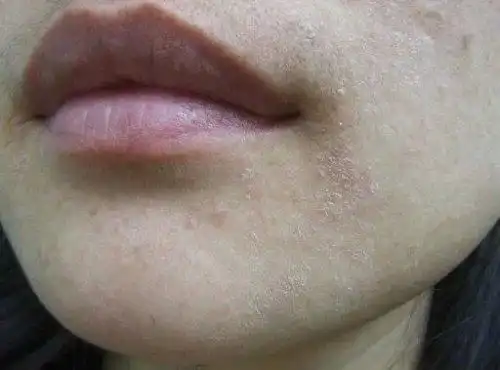 皮肤干燥紧绷怎么办?