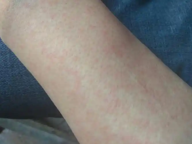 身上过敏去医院检查血后,医生说是病毒传染皮肤过敏,输液四天了,还是