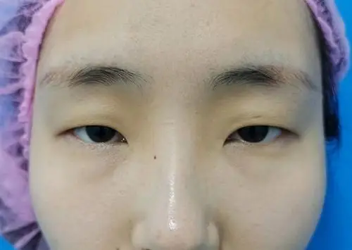 中度上睑下垂术前 小姑娘研究生在读,术前评估上睑下_圈子-新氧美容整