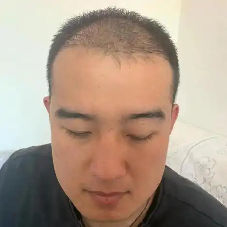 在25岁左右就出现了脱发,脱发已经成为普遍现象,男性脱发更是司空见惯