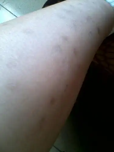 我的腿上起了很多的包包,又红又痒,但是现在已经变