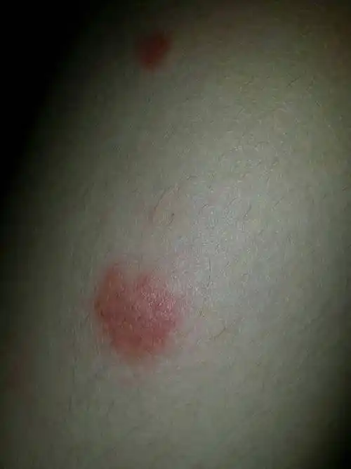 问:腿上被什么东西咬了 一开始以为是蚊子 现在又大了,痒痒的怎么办?