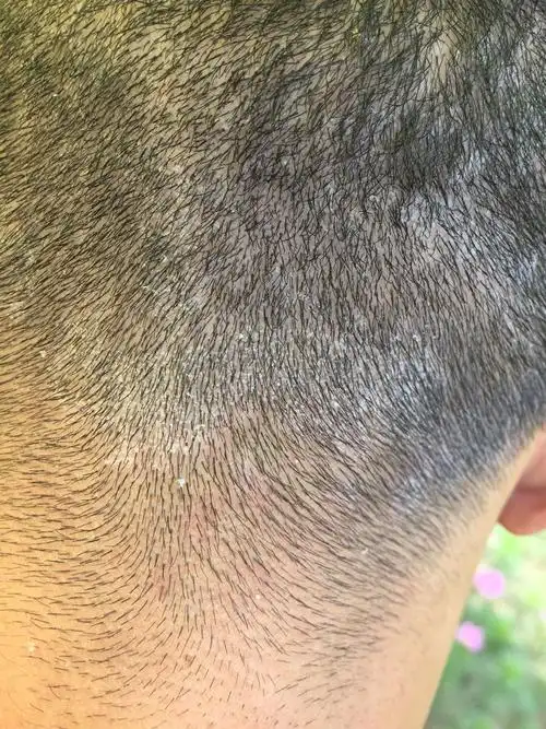 头皮长了一层癣状的,麻烦万能的网友帮忙看看