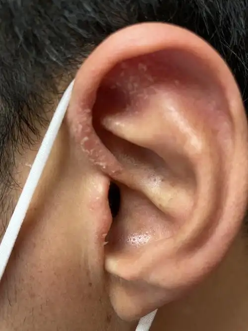 $冠昊生物(sz300238)$ 这个耳部的银屑病,今天配一个本维莫德,外周