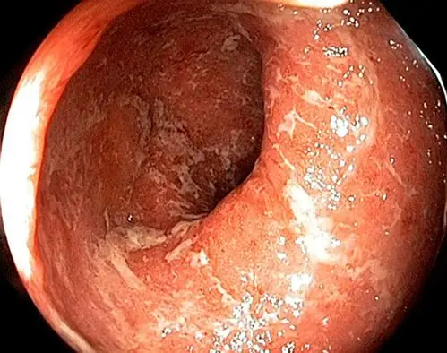 肛癌早期症状图片 (11)_有来医生